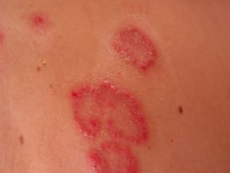 Ringelroeteln in der Schwangerschaft nach der 20. Woche